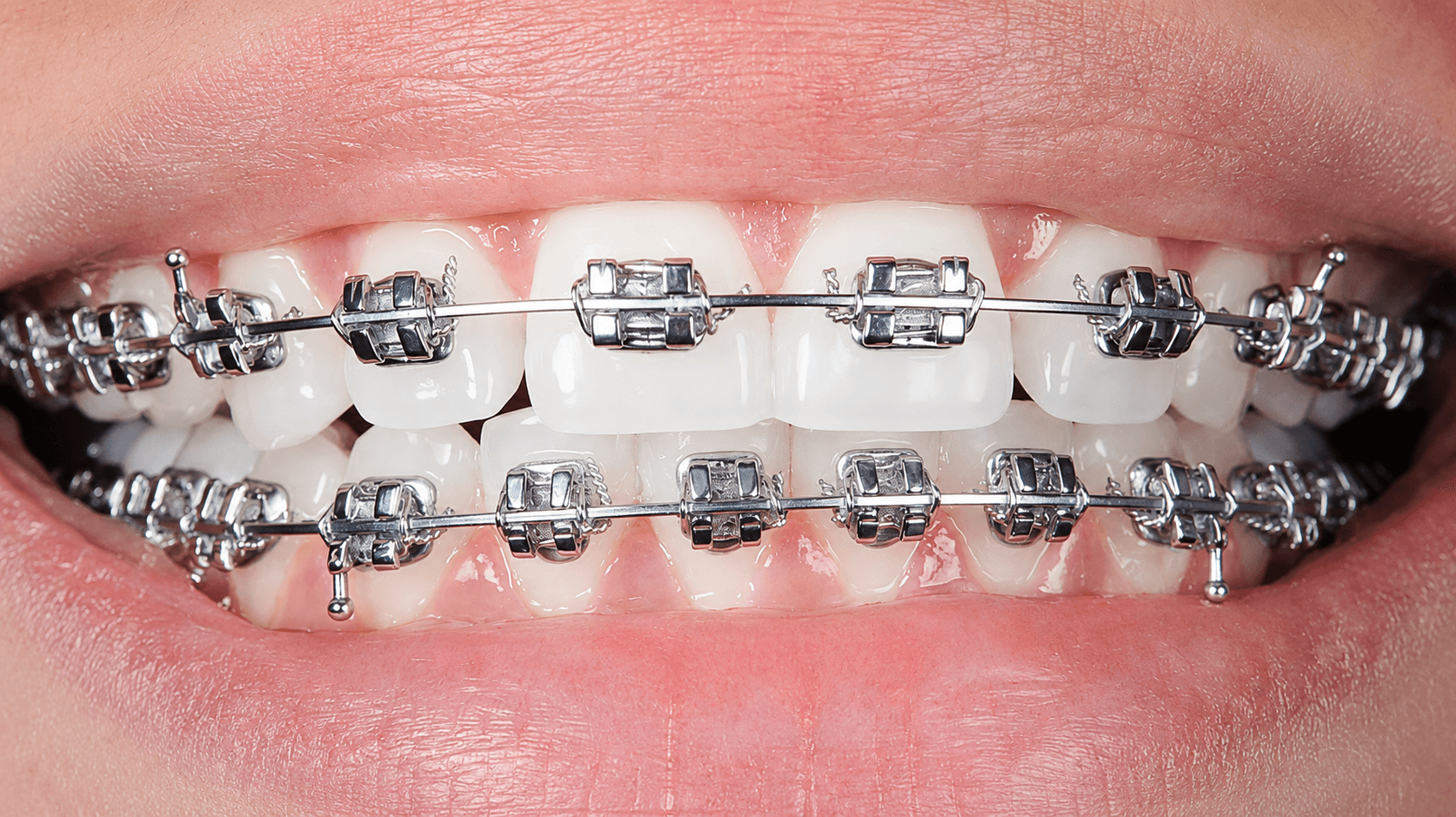 Orthodontic Treatment