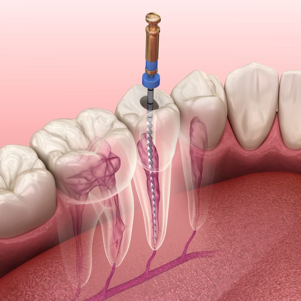 RCT (Root Canal Treatment)